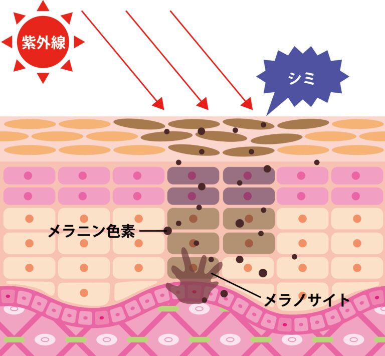早期発見が命！ 皮膚がん メラノーマ と ほくろ の見分け方 | 【細田塾】若手内科ドクター向け「総合診療」 「経営」を学ぶコミュニティ